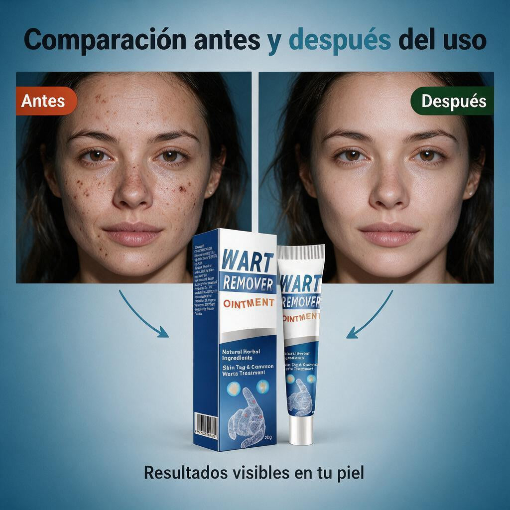 Wart Removedor Definitivo